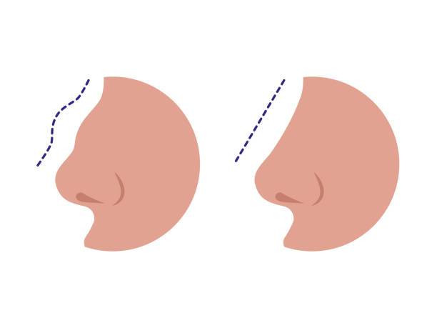 Rinoplastia ultrasónica - en qué consiste y cuales son sus beneficios 5 istockphoto 1197803576 612x612 2