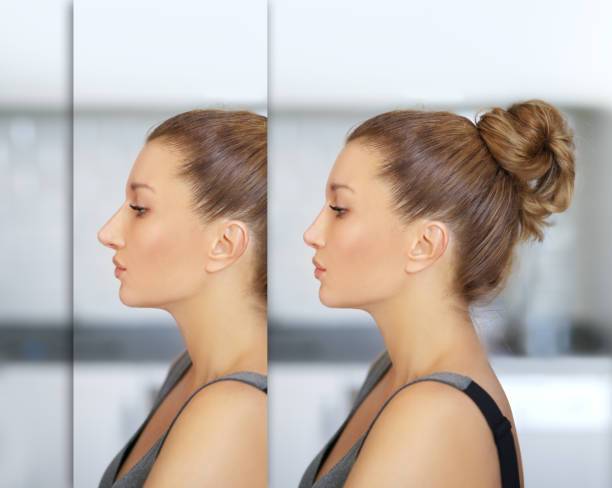 Rinoplastia ultrasónica - en qué consiste y cuales son sus beneficios 6 istockphoto 1256122720 612x612 1